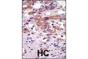 Formalin-fixed and paraffin-embedded human cancer tissue reacted with the primary antibody, which was peroxidase-conjugated to the secondary antibody, followed by AEC staining.