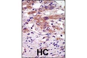 Formalin-fixed and paraffin-embedded human cancer tissue reacted with the primary antibody, which was peroxidase-conjugated to the secondary antibody, followed by AEC staining. (RPS6KA6 anticorps  (N-Term))