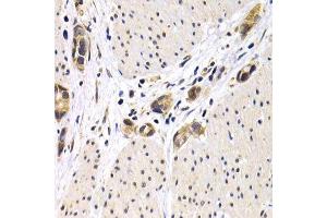 Immunohistochemistry of paraffin-embedded human gastric cancer using ATF2 antibody. (ATF2 anticorps  (AA 1-190))