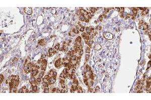 ABIN6278272 at 1/100 staining Human liver cancer tissue by IHC-P. (SLC9A3R1 anticorps  (Internal Region))
