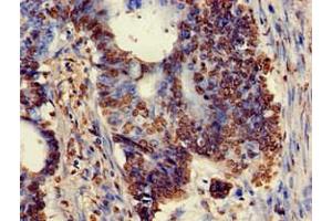 Immunohistochemistry of paraffin-embedded human colon cancer using ABIN7175897 at dilution of 1:100 (XRCC5 anticorps  (AA 251-455))