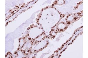 IHC-P Image Immunohistochemical analysis of paraffin-embedded human ovarian cancer, using RAD23B, antibody at 1:250 dilution. (RAD23B anticorps  (Center))