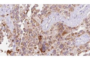 ABIN6273235 at 1/100 staining Human Melanoma tissue by IHC-P. (EGFL7 anticorps  (Internal Region))