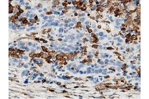 Immunohistochemical staining of paraffin-embedded Adenocarcinoma of Human colon tissue using anti-ARHGAP25 mouse monoclonal antibody. (ARHGAP25 anticorps)