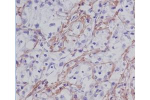 Immunohistochemical analysis of paraffin-embedded human liver cancer, using Fibronectin Antibody.