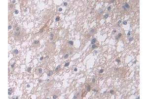 Detection of CPA4 in Human Glioma Tissue using Polyclonal Antibody to Carboxypeptidase A4 (CPA4) (CPA4 anticorps  (AA 55-421))