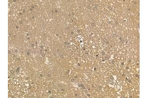 ABIN6262762 and ABIN6273258 at 1/100 staining human glioblastoma by IHC-P.