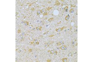 Immunohistochemistry of paraffin-embedded human brain cancer using CAMK1G Antibody (ABIN5975515) at dilution of 1/100 (40x lens). (CAMK1G anticorps)