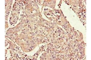 Immunohistochemistry of paraffin-embedded human cervical cancer using ABIN7167815 at dilution of 1:100 (Retinoid X Receptor gamma anticorps  (AA 13-133))