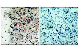 Immunohistochemical analysis of paraffin-embedded human breast carcinoma tissue using JAK1(Ab-1022) Antibody(left) or the same antibody preincubated with blocking peptide(right).