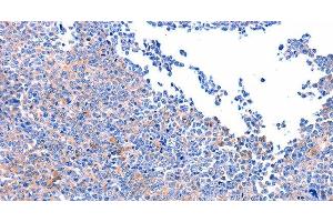 Immunohistochemistry of paraffin-embedded Human ovarian cancer using FAK Polyclonal Antibody at dilution of 1:75 (FAK anticorps)