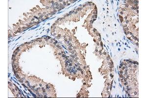 Immunohistochemical staining of paraffin-embedded Adenocarcinoma of Human ovary tissue using anti-BSG mouse monoclonal antibody. (CD147 anticorps)