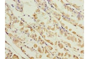 Immunohistochemistry of paraffin-embedded human gastric cancer using ABIN7157640 at dilution of 1:100 (KIF26B anticorps  (AA 8-133))