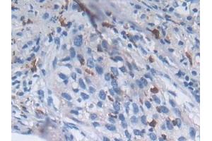 Detection of SEMA3E in Human Lung cancer Tissue using Polyclonal Antibody to Semaphorin 3E (SEMA3E)