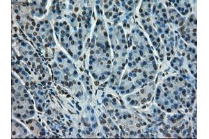 Immunohistochemical staining of paraffin-embedded Adenocarcinoma of colon tissue using anti-STK39mouse monoclonal antibody. (STK39 anticorps)