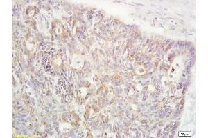 Formalin-fixed and paraffin embedded human rectal carcinoma labeled with Anti-RanBP1 Polyclonal Antibody, Unconjugated (ABIN1387616) at 1:200 followed by conjugation to the secondary antibody and DAB staining (RANBP1 anticorps  (AA 86-116))