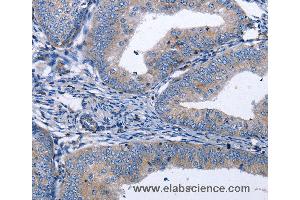 Immunohistochemistry of Human thyroid cancer using BDNF Polyclonal Antibody at dilution of 1:40 (BDNF anticorps)