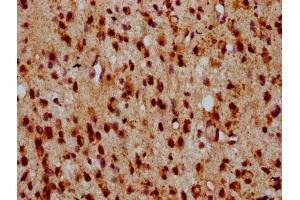 IHC image of ABIN7155865 diluted at 1:500 and staining in paraffin-embedded human glioma performed on a Leica BondTM system. (HIPK2 anticorps  (AA 816-977))