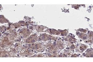 ABIN6273960 at 1/100 staining Human liver cancer tissue by IHC-P.