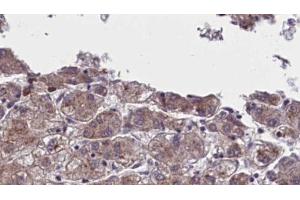 ABIN6273960 at 1/100 staining Human liver cancer tissue by IHC-P. (OR5AN1 anticorps  (Internal Region))