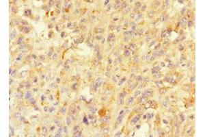 Immunohistochemistry of paraffin-embedded human melanoma using ABIN7160214 at dilution of 1:100 (MORN5 anticorps  (AA 1-161))