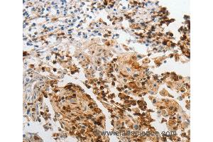 Immunohistochemistry of Human cervical cancer using LCN2 Polyclonal Antibody at dilution of 1:60 (Lipocalin 2 anticorps)