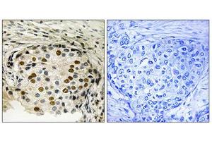 Immunohistochemistry analysis of paraffin-embedded human breast carcinoma tissue using OSR1 (Phospho-Thr185) antibody. (OSR1 anticorps  (pThr185))