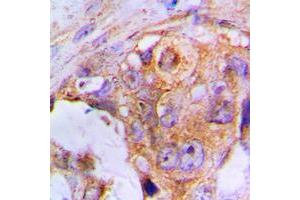 Immunohistochemical analysis of APAF-1 staining in human lung cancer formalin fixed paraffin embedded tissue section. (APAF1 anticorps  (C-Term))