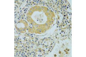 Immunohistochemistry of paraffin-embedded human lung cancer using PECR antibody (ABIN2564466) at dilution of 1:100 (40x lens). (PECR anticorps)