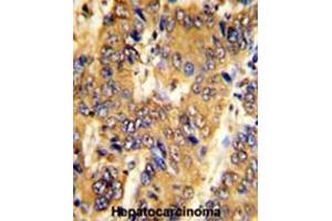 Formalin-fixed and paraffin-embedded human hepatocarcinoma with MSRB2 Antibody (Center), which was peroxidase-conjugated to the secondary antibody, followed by DAB staining. (MSRB2 anticorps  (Middle Region))