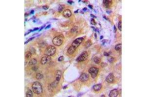 Immunohistochemical analysis of PTTG1/2/3 staining in human breast cancer formalin fixed paraffin embedded tissue section. (PTTG1/2/3 anticorps  (Center))