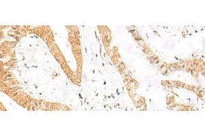 Immunohistochemistry of paraffin-embedded Human liver cancer tissue using HES7 Polyclonal Antibody at dilution of 1:25(x200) (HES7 anticorps)