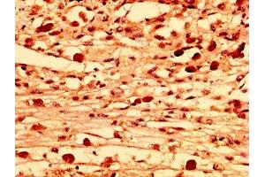 IHC image of ABIN7158070 diluted at 1:300 and staining in paraffin-embedded human melanoma performed on a Leica BondTM system.