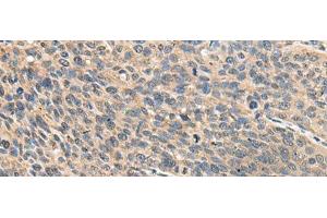 Immunohistochemistry of paraffin-embedded Human cervical cancer tissue using RPS14 Polyclonal Antibody at dilution of 1:50(x200)