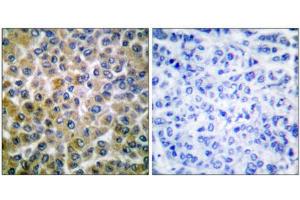 Immunohistochemistry analysis of paraffin-embedded human breast carcinoma tissue, using Smad1 (epitope around residue 465) antibody.