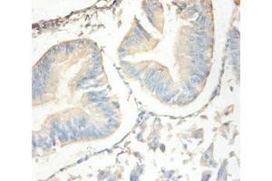 Immunohistochemistry of paraffin-embedded human endometrial cancer using ABIN7144333 at dilution of 1:100 (SLPI anticorps  (AA 26-132))