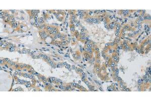 Immunohistochemistry of paraffin-embedded Human thyroid cancer tissue using Connexin-45 Polyclonal Antibody at dilution 1:50