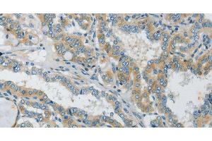 Immunohistochemistry of paraffin-embedded Human thyroid cancer tissue using Connexin-45 Polyclonal Antibody at dilution 1:50 (GJC1 anticorps)