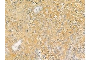 ABIN6264645 and ABIN6276782 at 1/100 staining human gastric carcinoma by IHC-P. (RASA1 anticorps  (C-Term))