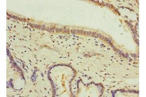 Immunohistochemistry of paraffin-embedded human prostate cancer using ABIN7153669 at dilution of 1:100 (GIPR anticorps  (AA 22-138))