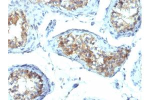 Formalin-fixed, paraffin-embedded human Testicular Carcinoma stained with Interferon gamma Mouse Monoclonal Antibody (IFNG/466).