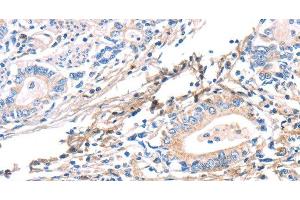 Immunohistochemistry of paraffin-embedded Human gastric cancer using TWF2 Polyclonal Antibody at dilution of 1:40 (TWF2 anticorps)