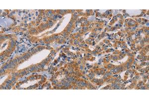 Immunohistochemistry of paraffin-embedded Human thyroid cancer tissue using CDK11A/B Polyclonal Antibody at dilution 1:50 (Cdk11A/B anticorps)