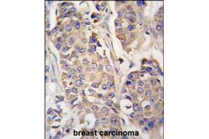 Formalin-fixed and paraffin-embedded human breast carcinoma tissue reacted with ACO2 antibody , which was peroxidase-conjugated to the secondary antibody, followed by DAB staining. (ACO2 anticorps  (AA 294-325))
