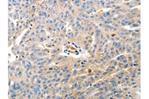 The image on the left is immunohistochemistry of paraffin-embedded Human ovarian cancer tissue using ABIN7190149(CD93 Antibody) at dilution 1/60, on the right is treated with synthetic peptide. (CD93 anticorps)