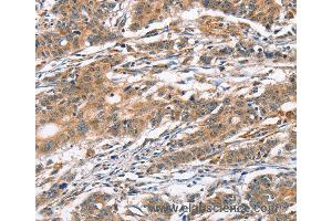Immunohistochemistry of Human breast cancer using CAMK4 Polyclonal Antibody at dilution of 1:40 (CAMK4 anticorps)