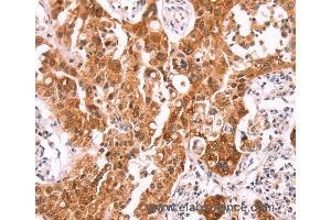 Immunohistochemistry of Human lung cancer using NCEH1 Polyclonal Antibody at dilution of 1:80 (NCEH1 anticorps)