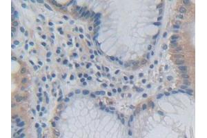 DAB staining on IHC-P; Samples: Human Stomach cancer Tissue (Growth Hormone 2 anticorps  (AA 27-217))