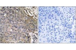 Immunohistochemistry analysis of paraffin-embedded human lung carcinoma, using SH2D1B Antibody. (SH2D1B anticorps  (AA 71-120))