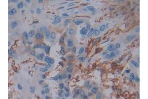 Detection of FTL in Human Breast cancer Tissue using Polyclonal Antibody to Ferritin, Light Polypeptide (FTL)